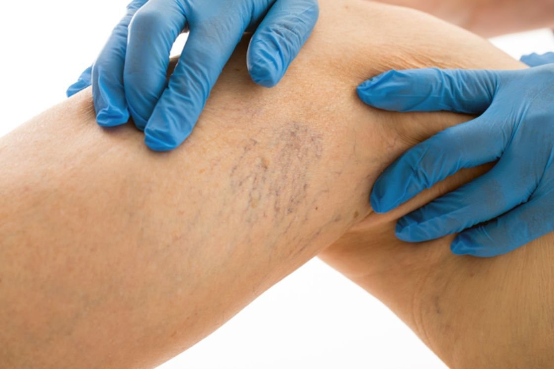 Why do varicose veins appear?
